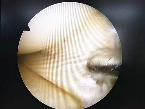 【永医前沿】骨科自主完成关节镜下膝关节骨性关节炎关节清理＋半月板成形术！