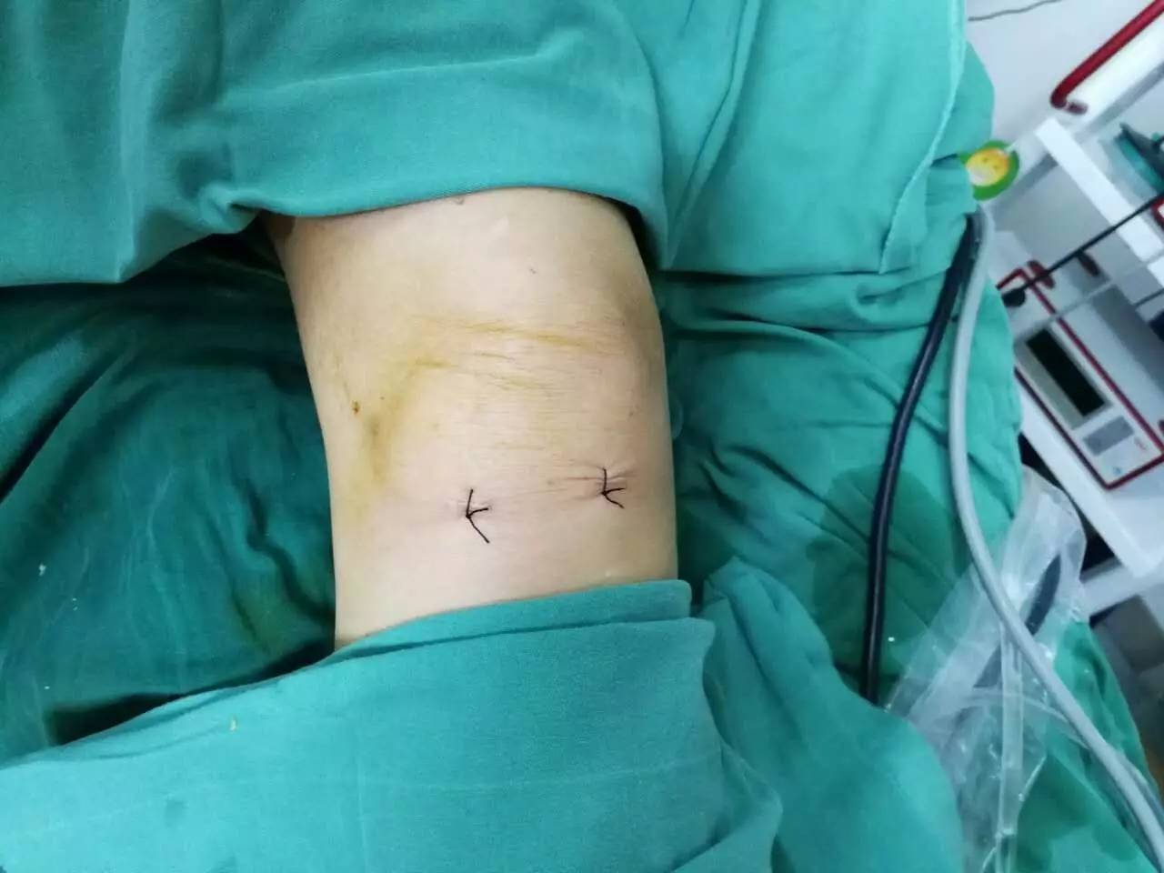 【永医前沿】骨科自主完成关节镜下膝关节骨性关节炎关节清理＋半月板成形术！